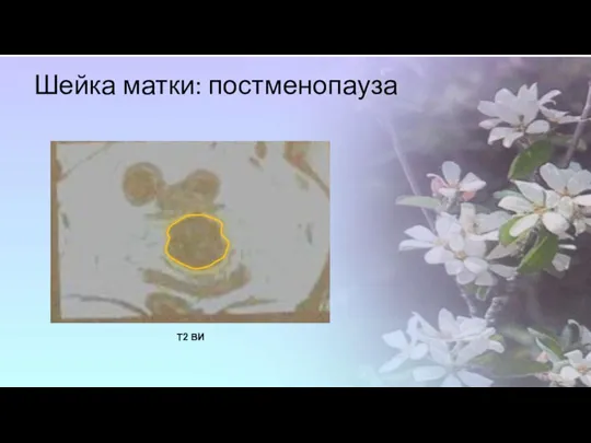 Шейка матки: постменопауза Т2 ВИ