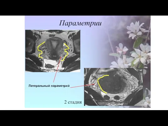 Параметрии 2 стадия Латеральный параметрий