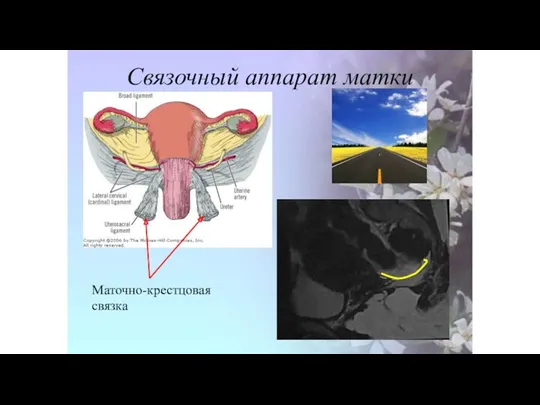 Связочный аппарат матки Маточно-крестцовая связка