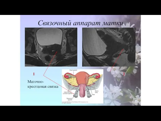 Связочный аппарат матки 1 2 Маточно-крестцовая связка