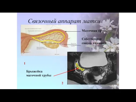 Связочный аппарат матки 1 2 Брыжейка маточной трубы Маточная труба Собственная связка яичника