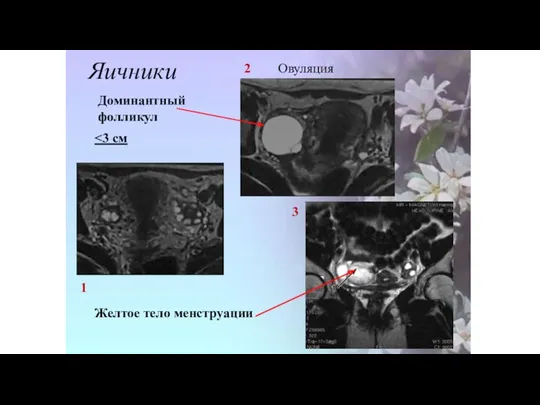 Яичники 1 2 Овуляция 3 Доминантный фолликул Желтое тело менструации