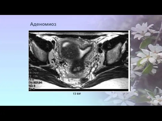 Т2 ВИ Аденомиоз