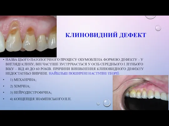 КЛИНОВИДНИЙ ДЕФЕКТ НАЗВА ЦЬОГО ПАТОЛОГІЧНОГО ПРОЦЕСУ ОБУМОВЛЕНА ФОРМОЮ ДЕФЕКТУ –