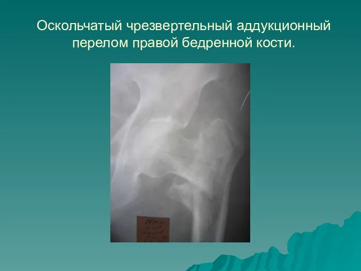 Оскольчатый чрезвертельный аддукционный перелом правой бедренной кости.