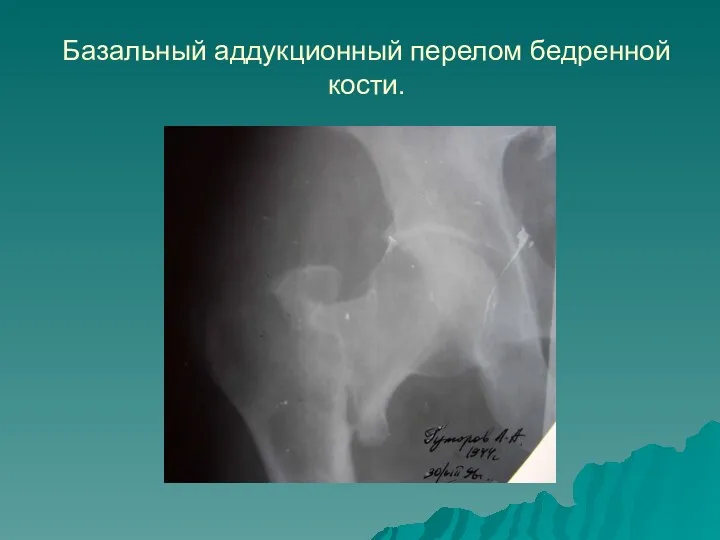 Базальный аддукционный перелом бедренной кости.