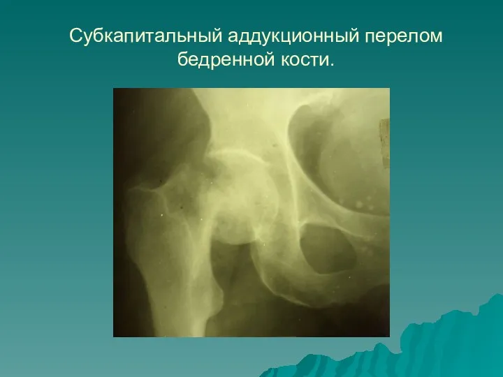 Субкапитальный аддукционный перелом бедренной кости.