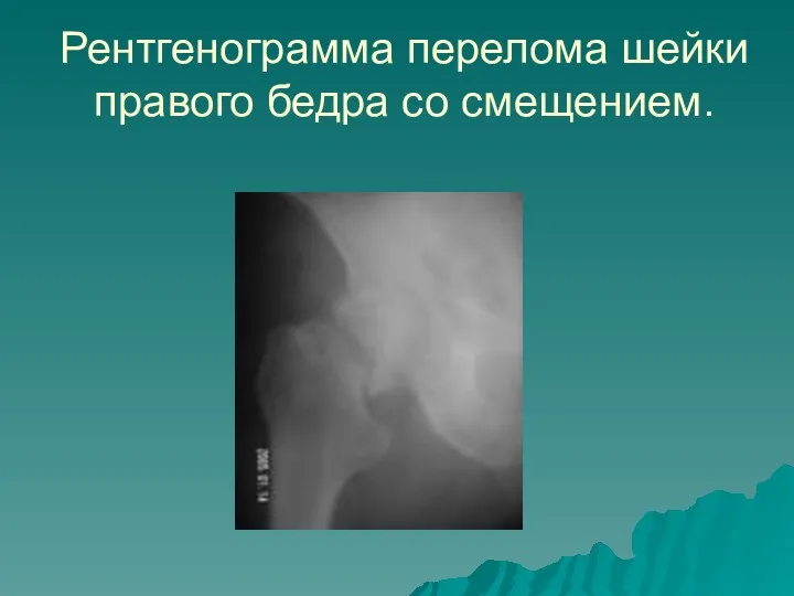 Рентгенограмма перелома шейки правого бедра со смещением.