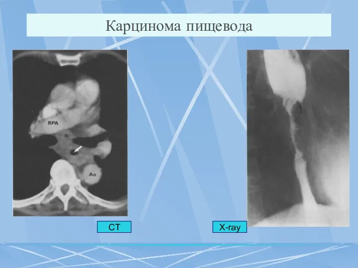 Карцинома пищевода CT X-ray