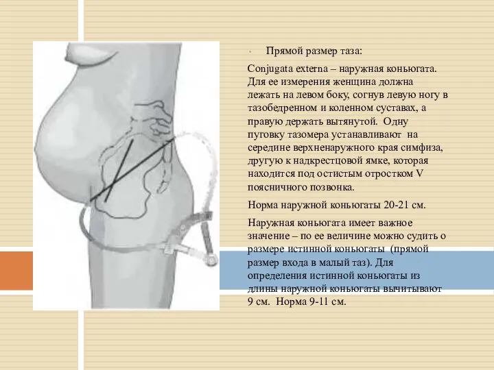 Прямой размер таза: Conjugata externa – наружная коньюгата. Для ее