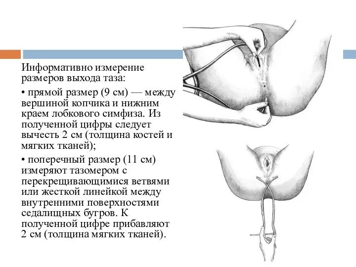 Информативно измерение размеров выхода таза: • прямой размер (9 см)