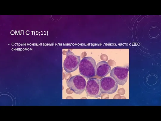 ОМЛ С T(9;11) Острый моноцитарный или миеломоноцитарный лейкоз, часто с ДВС синдромом