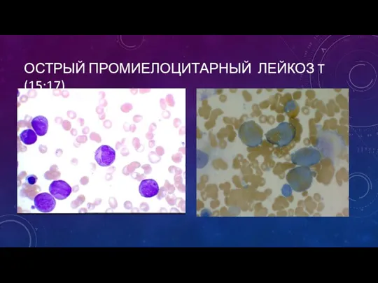 ОСТРЫЙ ПРОМИЕЛОЦИТАРНЫЙ ЛЕЙКОЗ T (15;17)