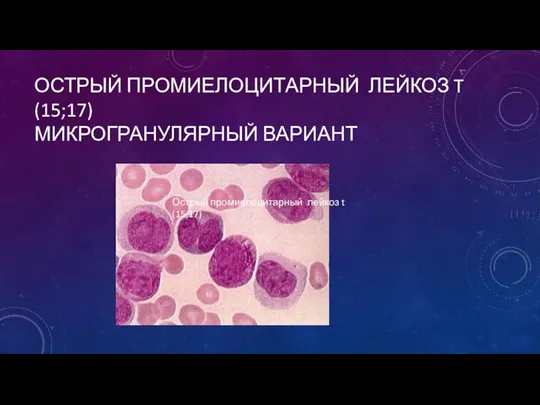 ОСТРЫЙ ПРОМИЕЛОЦИТАРНЫЙ ЛЕЙКОЗ T (15;17) МИКРОГРАНУЛЯРНЫЙ ВАРИАНТ Острый промиелоцитарный лейкоз t (15;17)