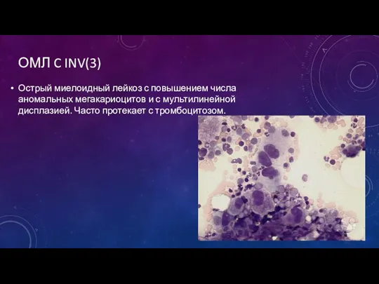 ОМЛ C INV(3) Острый миелоидный лейкоз с повышением числа аномальных