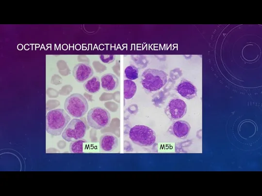 ОСТРАЯ МОНОБЛАСТНАЯ ЛЕЙКЕМИЯ