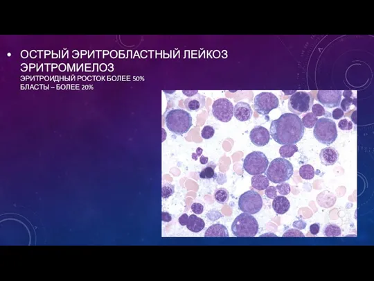 ОСТРЫЙ ЭРИТРОБЛАСТНЫЙ ЛЕЙКОЗ ЭРИТРОМИЕЛОЗ ЭРИТРОИДНЫЙ РОСТОК БОЛЕЕ 50% БЛАСТЫ – БОЛЕЕ 20%