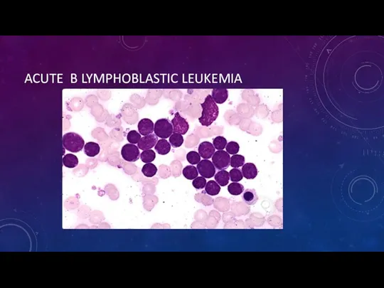 ACUTE B LYMPHOBLASTIC LEUKEMIA