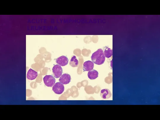 ACUTE B LYMPHOBLASTIC LEUKEMIA