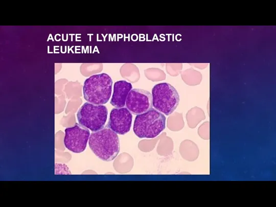 ACUTE T LYMPHOBLASTIC LEUKEMIA