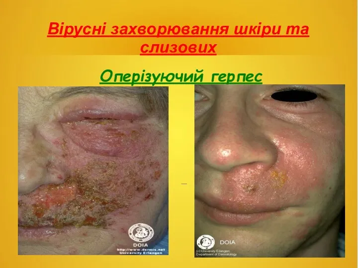 Вірусні захворювання шкіри та слизових Оперізуючий герпес .