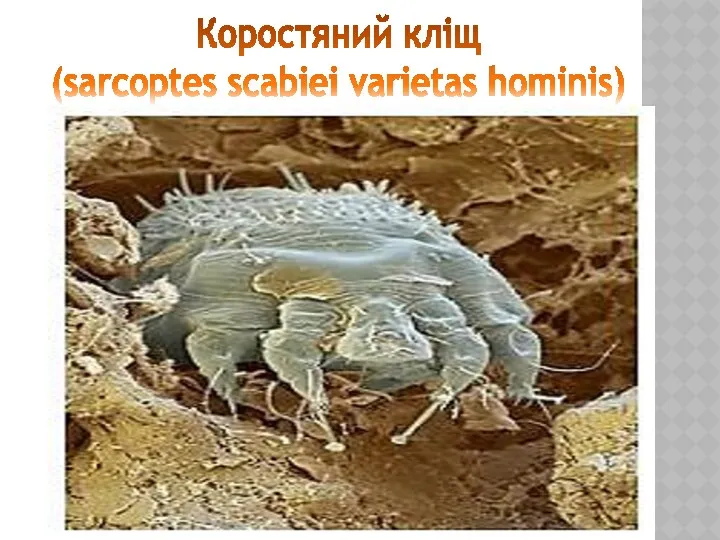 Коростяний кліщ (sarcoptes scabiei varietas hominis)