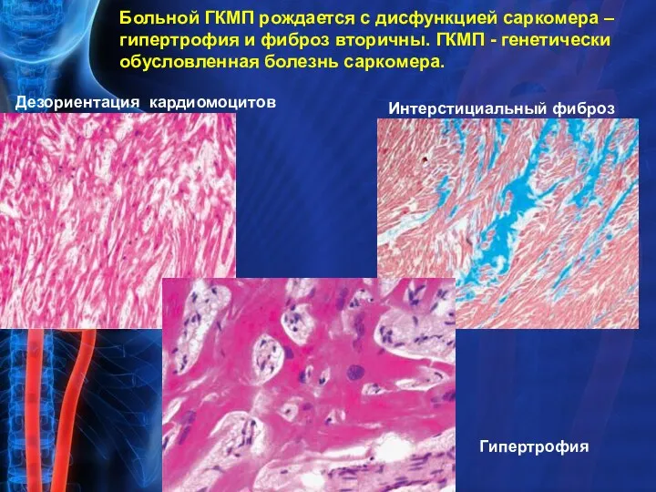 Больной ГКМП рождается с дисфункцией саркомера – гипертрофия и фиброз