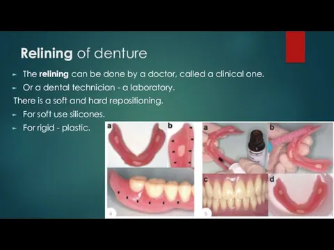 Relining of denture The relining can be done by a doctor, called a