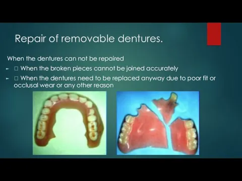 Repair of removable dentures. When the dentures can not be repaired  When