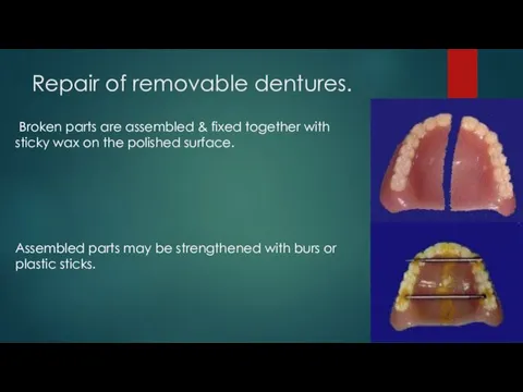 Repair of removable dentures. Broken parts are assembled & fixed together with sticky