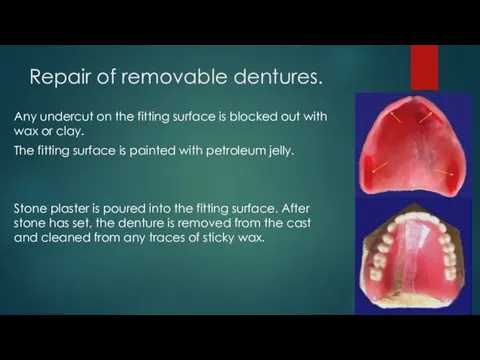 Repair of removable dentures. Any undercut on the fitting surface is blocked out