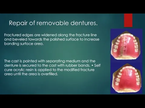 Repair of removable dentures. Fractured edges are widened along the fracture line and