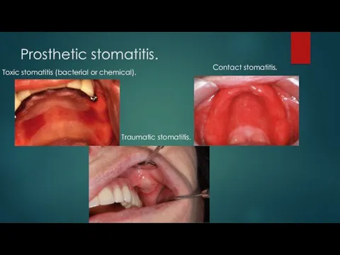 Prosthetic stomatitis. Traumatic stomatitis. Toxic stomatitis (bacterial or chemical). Contact stomatitis.