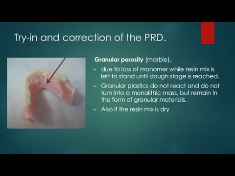 Try-in and correction of the PRD. Granular porosity (marble), due to loss of