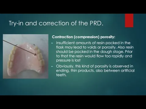 Try-in and correction of the PRD. Contraction (compression) porosity: Insufficient amounts of resin