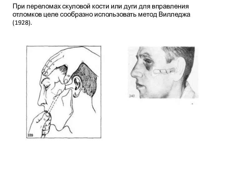 При переломах скуловой кости или дуги для вправления отломков целе­ сообразно использовать метод Вилледжа (1928).