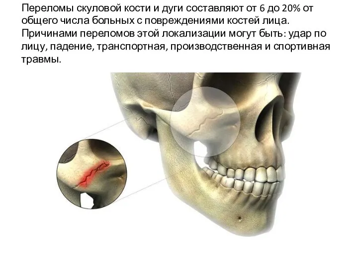 Переломы скуловой кости и дуги составляют от 6 до 20%