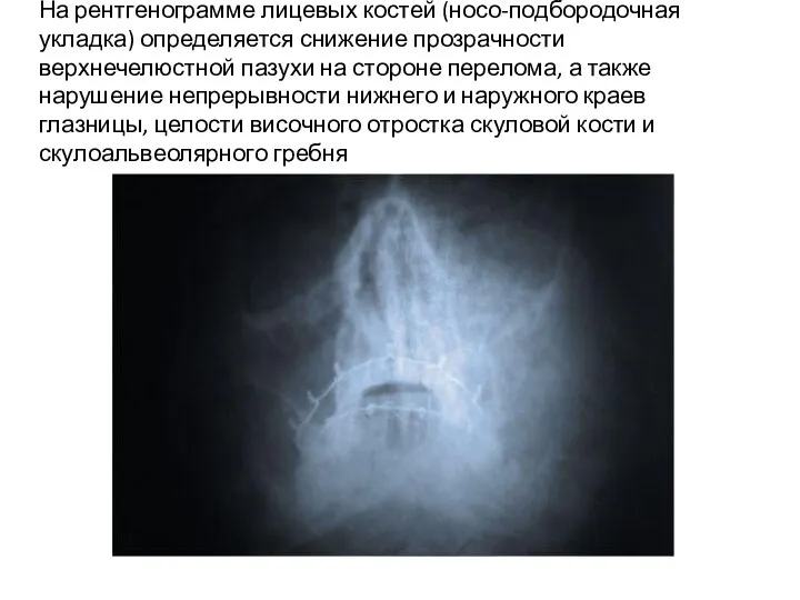 На рентгенограмме лицевых костей (носо-подбородочная укладка) определяется снижение прозрачности верхнечелюстной