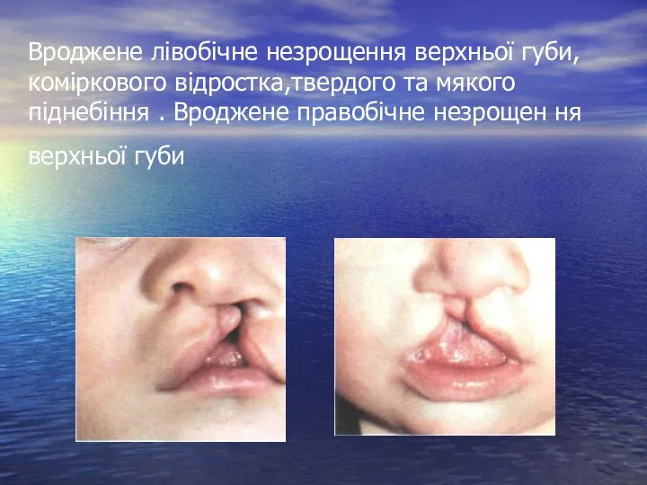 Вроджене лівобічне незрощення верхньої губи, коміркового відростка,твердого та мякого піднебіння