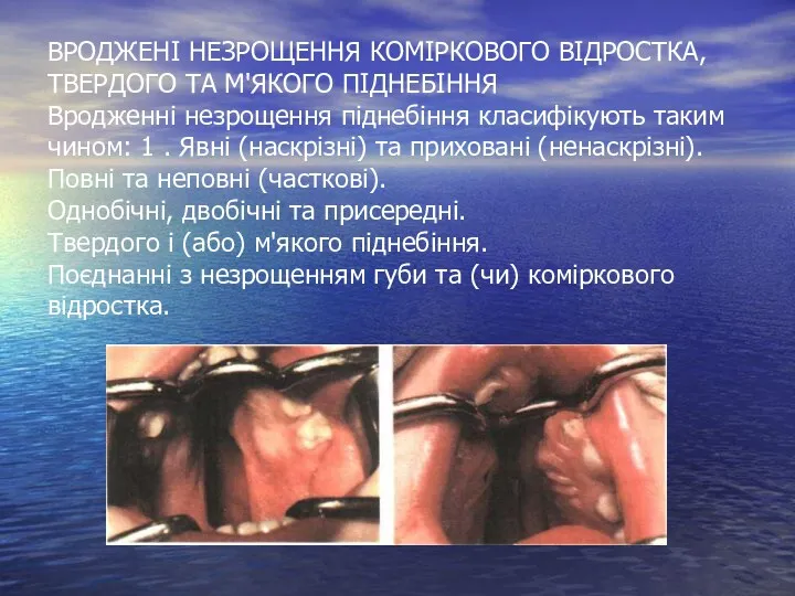 ВРОДЖЕНІ НЕЗРОЩЕННЯ КОМІРКОВОГО ВІДРОСТКА, ТВЕРДОГО ТА М'ЯКОГО ПІДНЕБІННЯ Вродженні незрощення