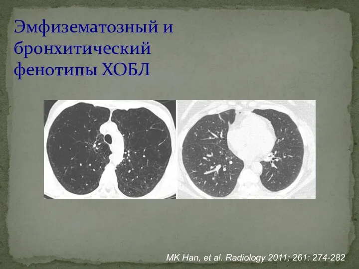 Эмфизематозный и бронхитический фенотипы ХОБЛ MK Han, et al. Radiology 2011; 261: 274-282