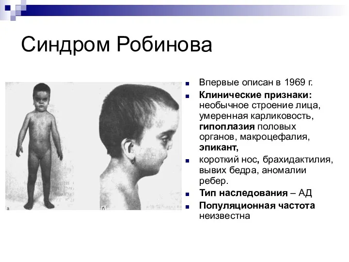 Синдром Робинова Впервые описан в 1969 г. Клинические признаки: необычное строение лица, умеренная