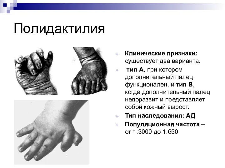 Полидактилия Клинические признаки: существует два варианта: тип А, при котором дополнительный палец функционален,