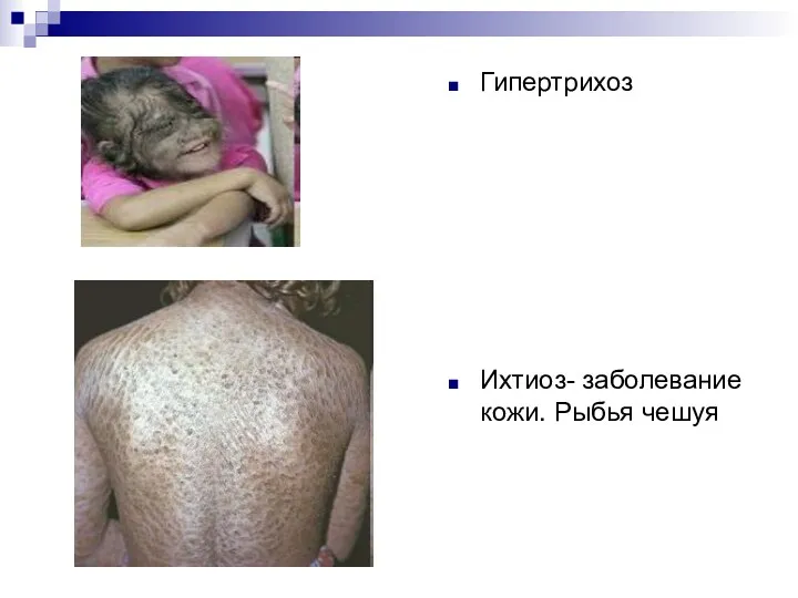 Гипертрихоз Ихтиоз- заболевание кожи. Рыбья чешуя