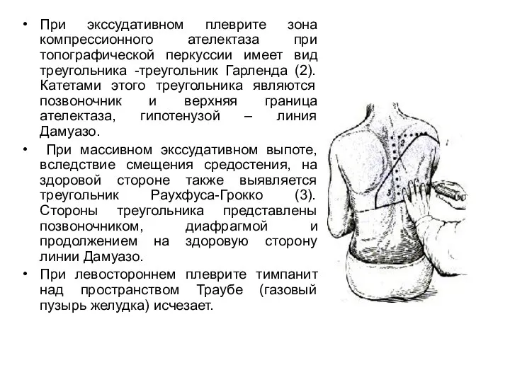 При экссудативном плеврите зона компрессионного ателектаза при топографической перкуссии имеет