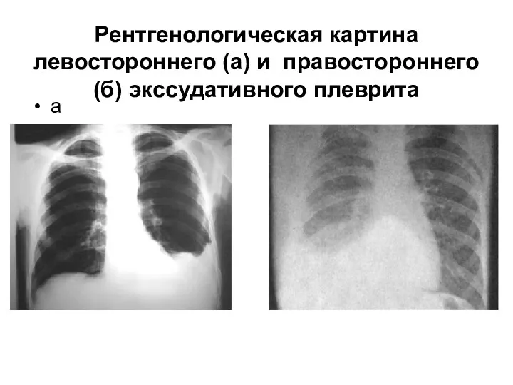 Рентгенологическая картина левостороннего (а) и правостороннего (б) экссудативного плеврита а