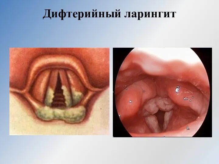 Дифтерийный ларингит