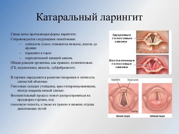 Катаральный ларингит Самая легко протекающая форма ларингита Сопровождается следующими симптомами: осиплость (голос становится