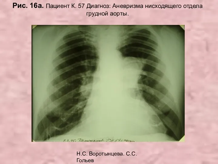 Н.С. Воротынцева. С.С. Гольев Рентгенопульмонология Рис. 16а. Пациент К. 57 Диагноз: Аневризма нисходящего отдела грудной аорты.