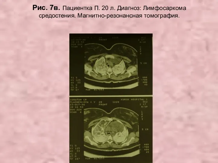 Н.С. Воротынцева. С.С. Гольев Рентгенопульмонология Рис. 7в. Пациентка П. 20 л. Диагноз: Лимфосаркома средостения. Магнитно-резонансная томография.